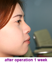 plastic_surgery_augmentation_rhinoplasty